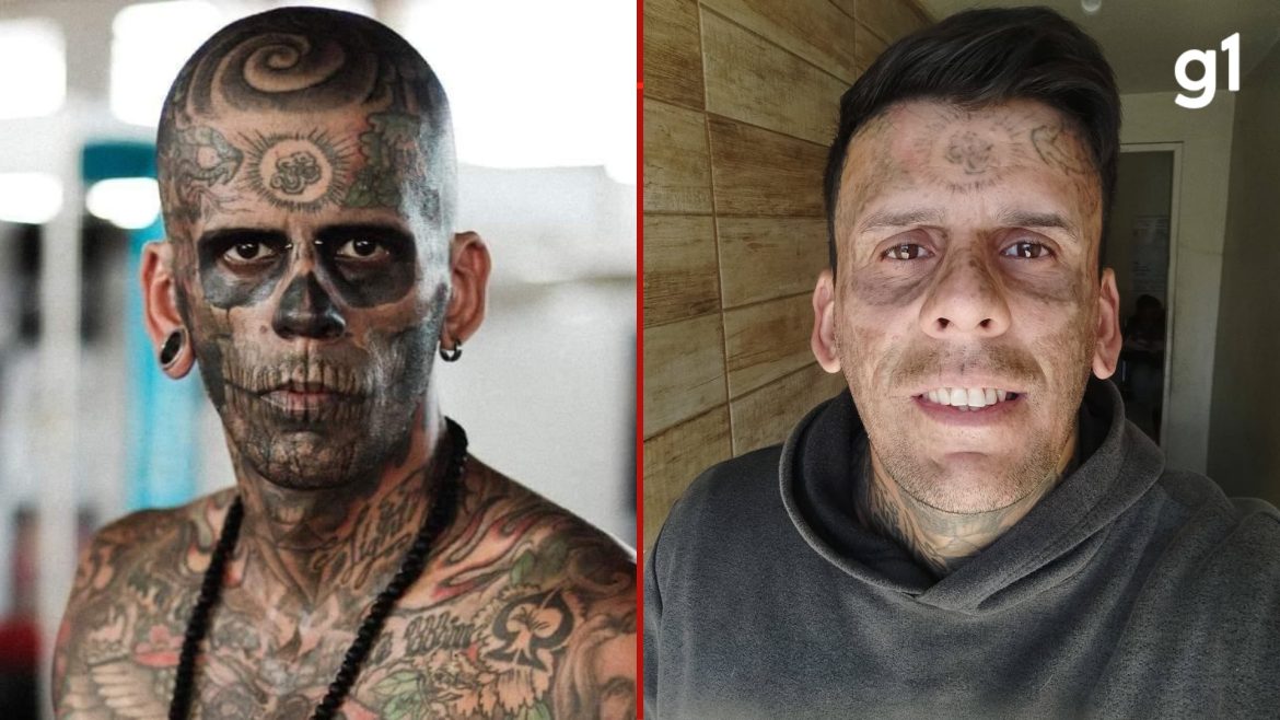 lembra-dele?-‘mais-tatuado-do-brasil’-passa-por-4a-sessao-de-remocao-de-tatuagens-no-rosto-e-compartilha-resultados