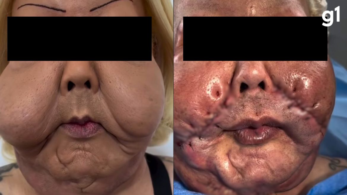 como-foi-cirurgia-de-‘juju-do-pix’-para-retirar-oleo-mineral-do-rosto