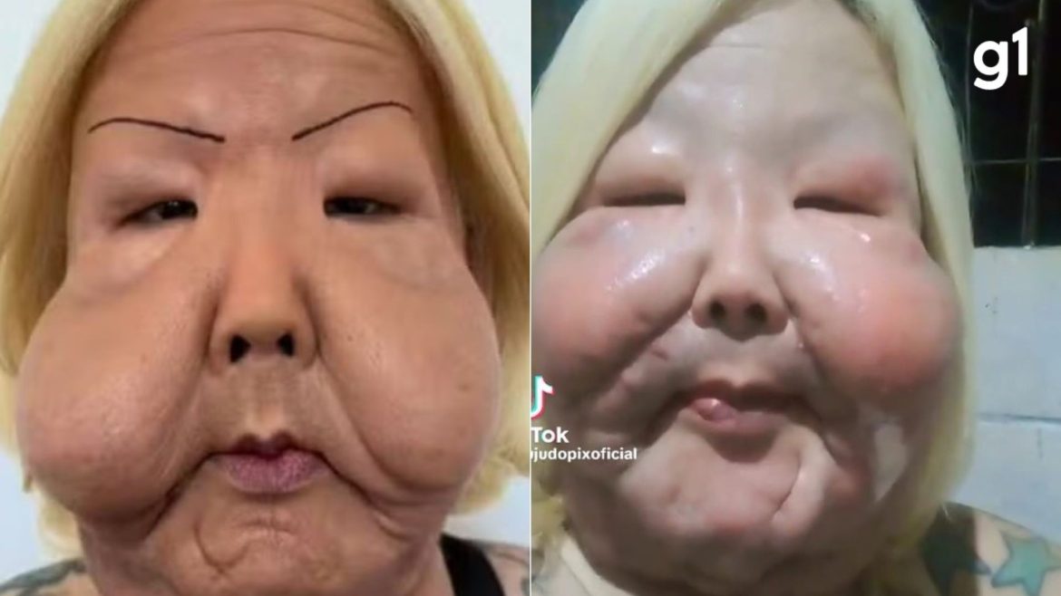 juju-do-pix-relata-problema-em-cicatrizacao-apos-cirurgia-para-retirada-de-oleo-mineral:-‘ponto-acabou-abrindo’
