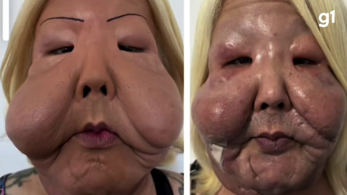 ‘refinamento’:-juju-do-pix-passa-por-nova-cirurgia-para-retirada-de-oleo-mineral-da-face