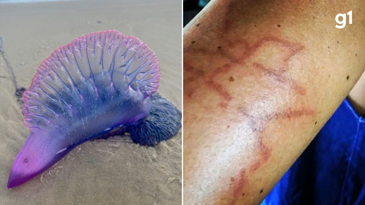 caravelas-portuguesas-causam-mais-de-500-queimaduras-em-um-dia-em-praia-do-rs;-saiba-o-que-fazer-em-caso-de-contato-com-a-pele